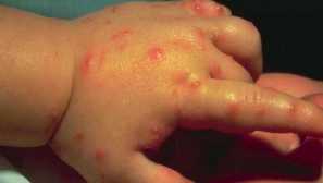 Как да хапят грешките на човек и как да се предпазим от хапки